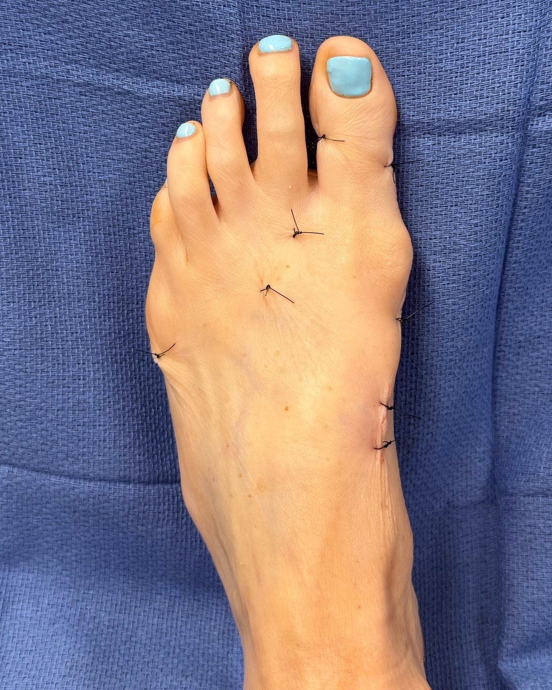 Same right foot immediately after The Jiffy Bunion™ with stitched 1 mm incisions