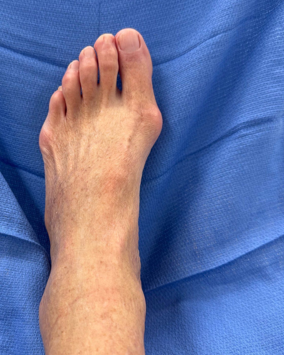 De-identified pre-op clinical foot photo showing bunion deformity