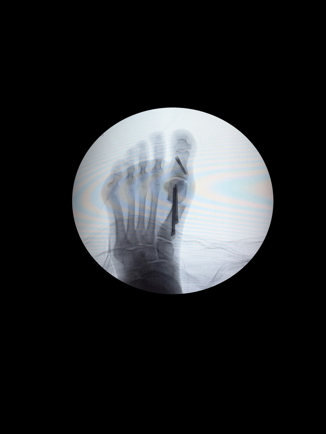 De-identified same-day post-op fluoroscopy X-ray showing straightened bone and 2 headless screws