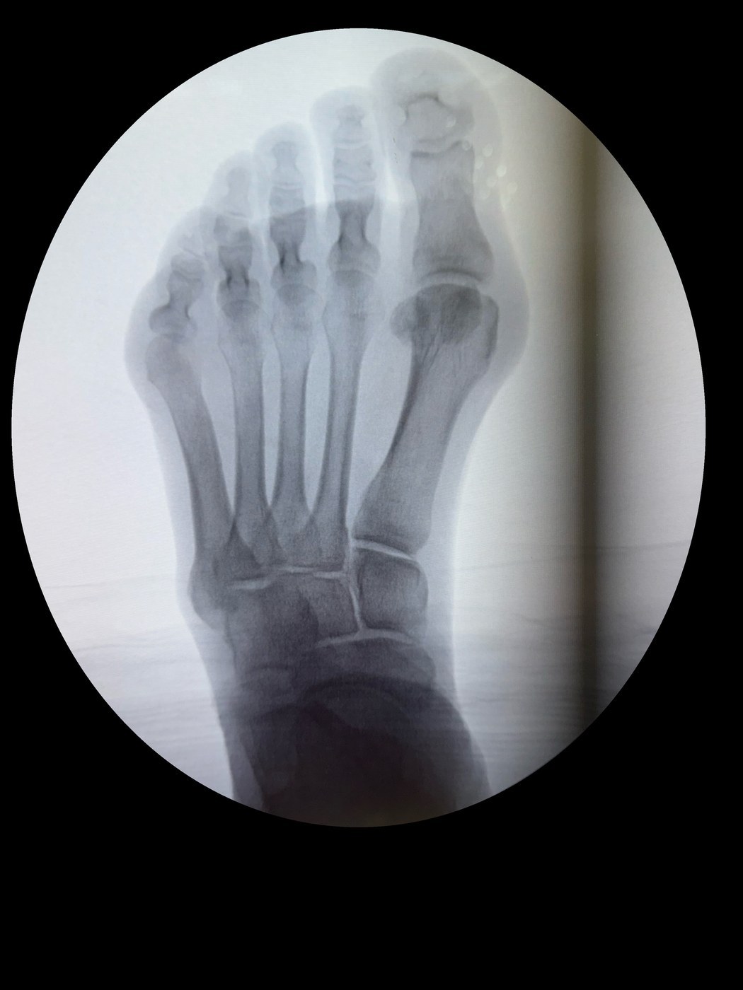 De-identified pre-op fluoroscopy X-ray showing hallux valgus bunion angle